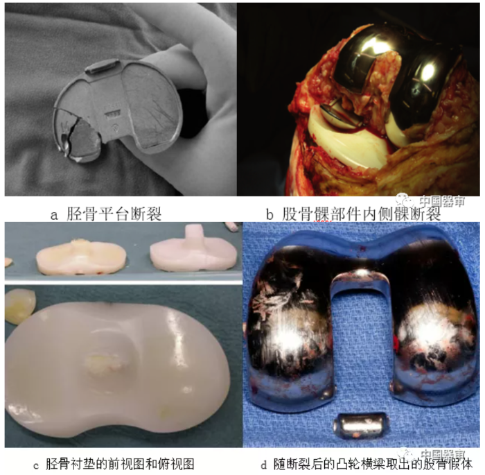 圖2 全膝關(guān)節(jié)假體部件失效模式及舉例